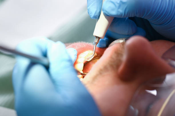 Best Emergency Dental Extractions in Southmont, PA